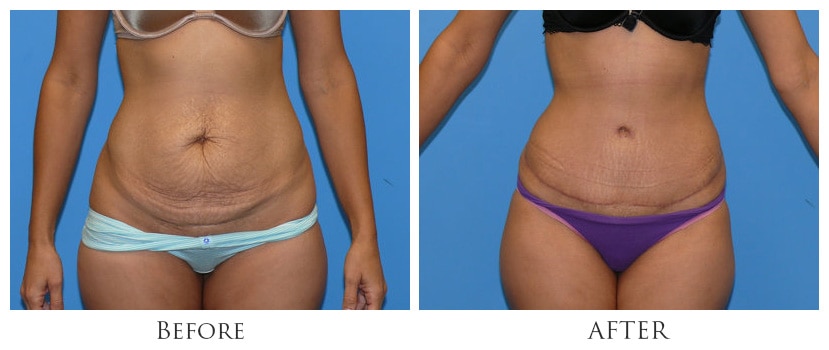 What Can I Expect After a Tummy Tuck?