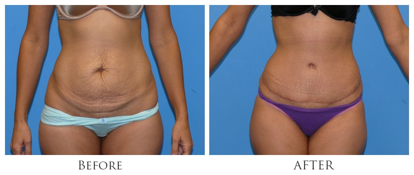 Tummy Tuck - BeautyBlade Plastic Surgery